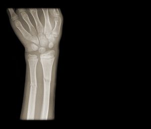 greenstick fracture